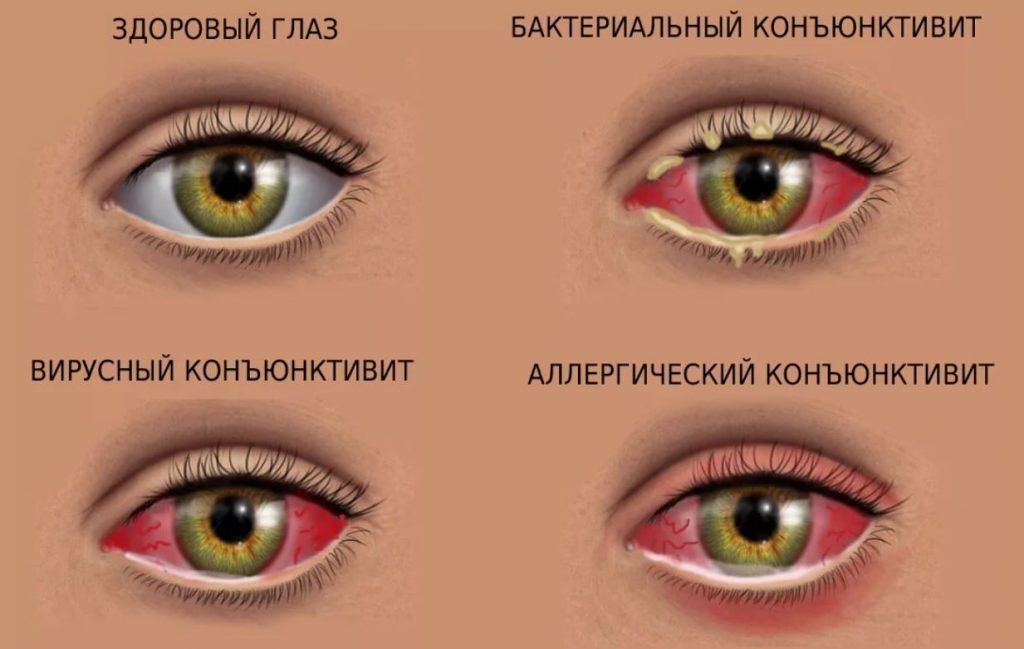 виды конъюнктивита