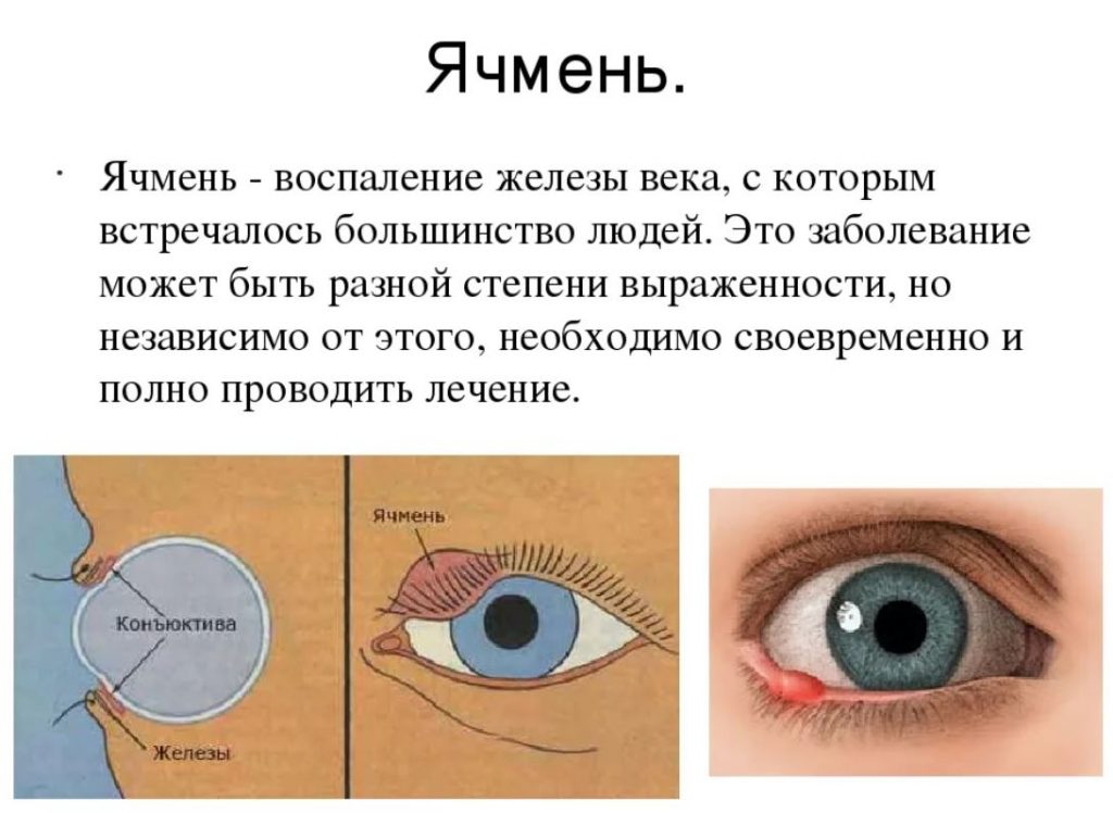 ячмень у ребенка